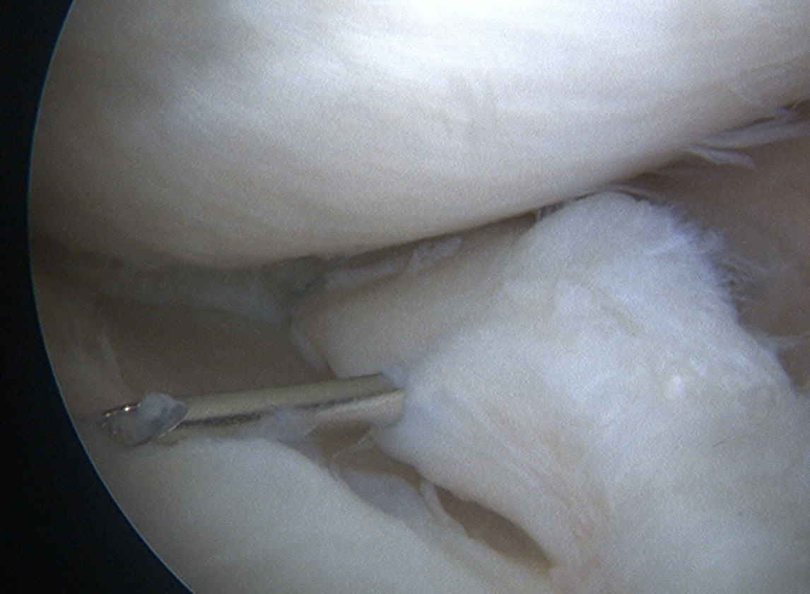 Meniscal Repair Outside In First Needle